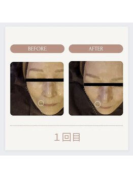 美々庵/光フェイシャル◆