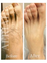 エアリアル 玉名店/メンズ足甲指のビフォーアフター