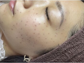 モテ美白/カウンセリング