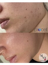 リベルテ(Liberte)/プロセルフェイシャル