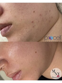 リベルテ(Liberte)/プロセルフェイシャル