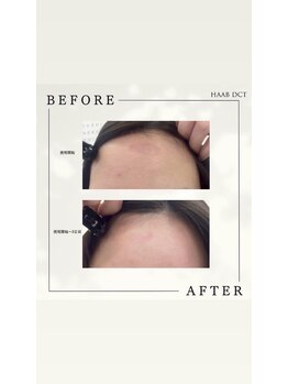 プラウディア(PROUDIA)/肌荒れ/韓国/肌管理／肌荒れ