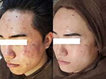 肌悩み改善へ導く本気の技術！長年の実績と知識に基づく緻密な施術プラン