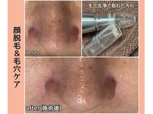 ベルミーランド 浜松天王/フェイシャルBefore→After