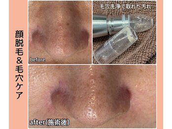 ベルミーランド 浜松天王/フェイシャルBefore→After