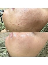 アシュレ リル 西多賀店(assure Lilou)/剥離なし◎ハーブピーリング