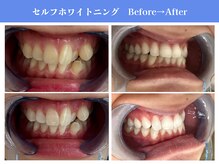 エクシアホワイトニング 岡崎店/セルフホワイトニングNo.1の実績
