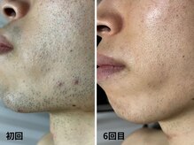 アヴィーシャル(abeshial)の雰囲気（【脱毛】脱毛するたび笑顔が増える！磨くほど、自信が輝く）