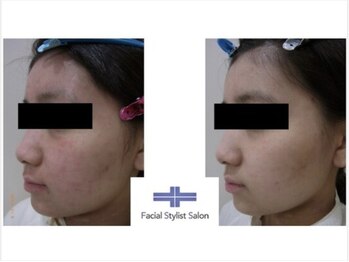 フェイシャルスタイリストサロン 四谷店/ケア例(36)