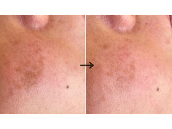 ラエッセ 恵比寿(LAESSE)/毛穴・美白専門店 LAESSE 恵比寿