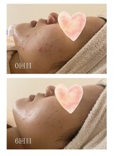 エモベーシック(e'MO BASIC)/ニキビケア脂性肌も段階的に改善