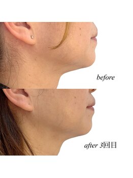 アイビー(Ivy)/レモンボトル/お首・アゴ下