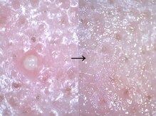 アンティアージュ 福岡本店(antiage)/肌荒れを根本から改善♪