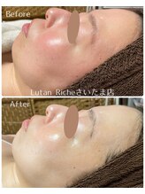 ルタンリッシュ さいたま店(Lutan Riche)/陶肌トリートメント 赤ら顔ケア