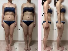 プラスワンビューティテン 新大阪店(Plus One Beauty)/ボディ/ハイパーナイフ/痩身