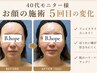 【二重あご・ほうれい線が気になる方へ】お顔のたるみケア￥33000→￥13200