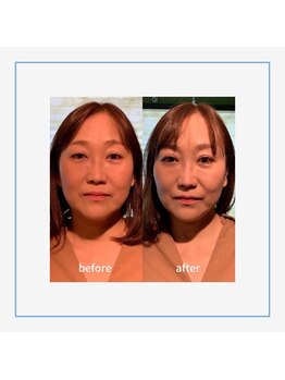 ティエドゥール エム(tiedeur × EMU)/ヘッドスパで小顔