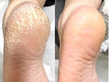 ウェルネスマルカ(wellness MARCA)/エンザイム角質ビットケア