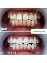 ホワイトニングサロン 名古屋駅店/【ホワイトニング施術例】