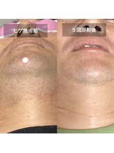 リリー(RILY)/【ビフォーアフター】