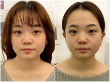 ア ニュームーン 明石ビブレ店(a New Moon)/小顔矯正　ビフォーとビフォー