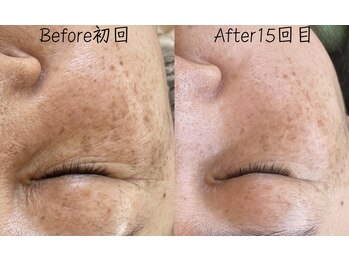 エリア(area.)/3、【シミケア25分】