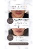 【メンズ脱毛】お顔全体脱毛(お顔全体＋首まで施術) 何度でもOK¥6000→5000