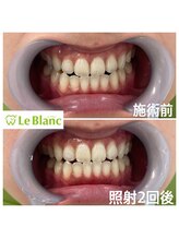 ルブラン 奈良店(Le Blanc)/ホワイトニング気になる方！