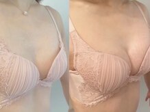 美人バスト 川崎店/バストアップ◇症例◇