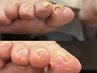 【巻き爪補正・フットトラブル相談】初回カウンセリング＋フットケア