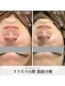 男女【小顔/二重あご】1回でスッキリ★プラズマ脂肪分解 体験22000⇒16500円