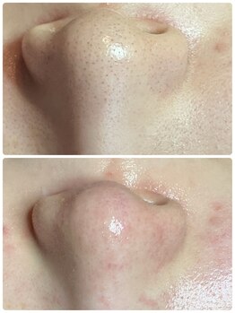 リンカ(Rinca)/黒ずみザラツキ消えた!