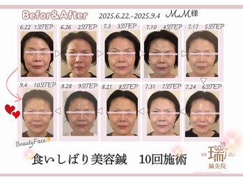 瑞 鍼灸院/ビフォーアフター美容鍼