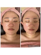 BBC 田園調布/小顔コルギの効果♪