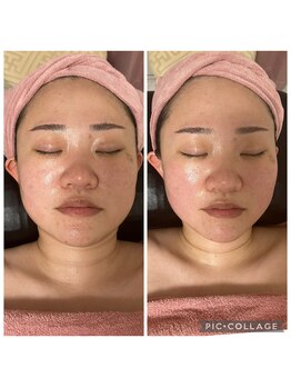 BBC 田園調布/小顔コルギの効果♪