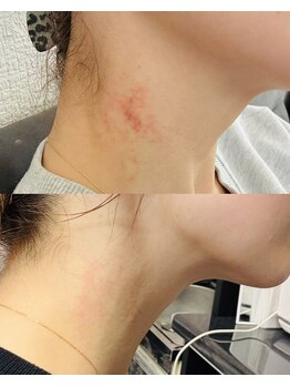 ルーク(Luke)/肌荒れ/赤み/痒み