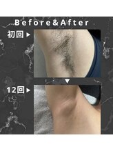 シック 南風原店(Chic)/ワキ脱毛　Before&After 12回後