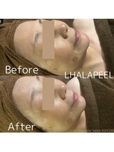 カヨン 新所沢店(KAYON)/ララピール ビフォーアフター