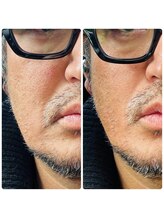 ラローズ(La Rose)/メンズ◆ほうれい線ケア