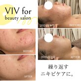 ヴィヴフォー(VIV for)