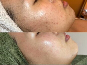 ピブ(PIBU)/ニキビ症例/ハーブピーリング