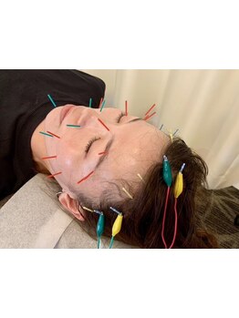 鍼灸施術を受けたい