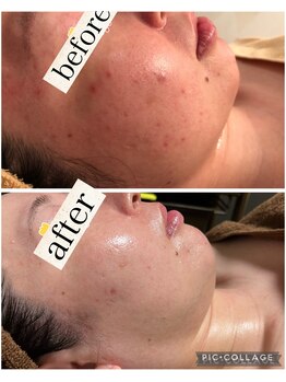 リープ(Lieb)/ハーブピーリング、基礎化粧品