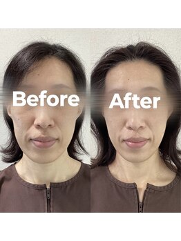 レオ(LEO)/Before→After