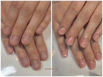 キュアネイル(Qa Nail)/ハンド【深爪矯正】初日変化！