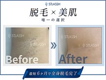 ストラッシュ 横浜駅前店/メニュー：全身脱毛（ワキ/脇）