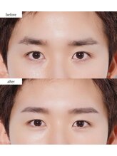 ラキ(LAKI)/HBL ビフォーアフター