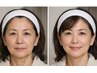 リフトアップフェイシャル・たるみ、二重あご解消!フェイスラインすっきり!