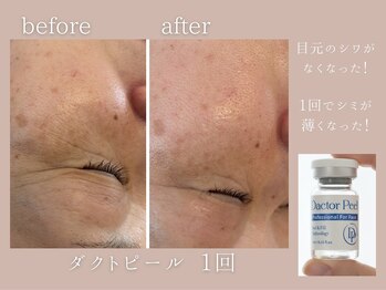 ココロミ(cocoromi)/ダクトピール