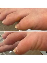 なかやまネイルクリニック/タコ・魚の目